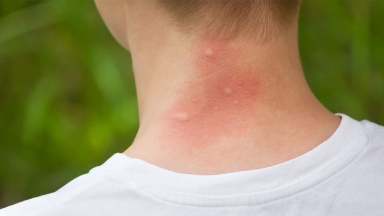 蚊に刺されたらまずやることは？痒みを抑える方法は？　意外と知らない正しい対処法